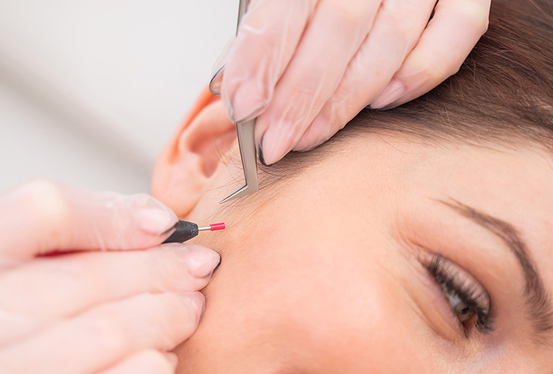 Electrolysis Treatments in Crouch End - Lux Wax