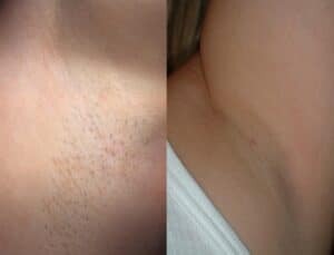 MeDioStar laser hair removal before/after