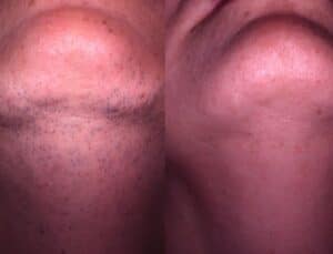 MeDioStar laser hair removal before/after
